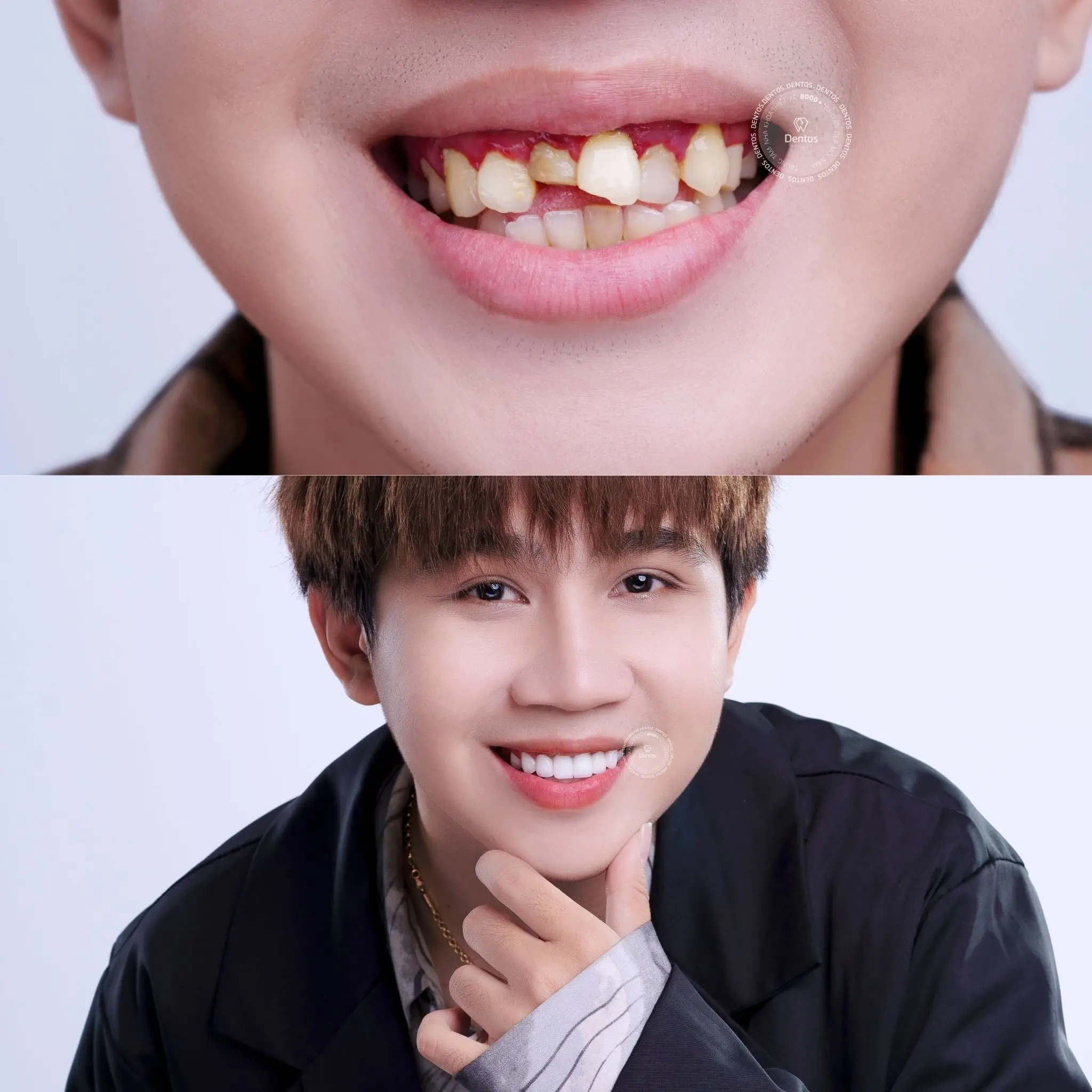 Phương pháp làm cầu răng sứ được sử dụng từ rất lâu trước khi kỹ thuật Implant ra đời